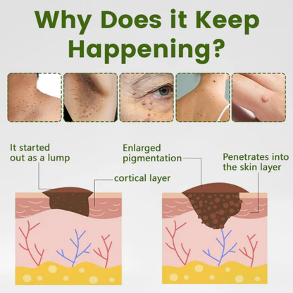 LOVILDS® ThujaClear Botanical Wart Cream