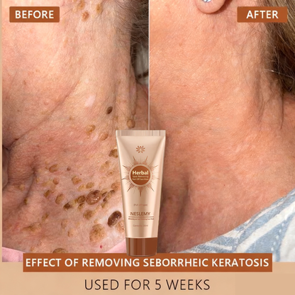 🔥🔥Black Friday Hot Selling-Whitening and Spot-Removing Face Mask Suitable for face and body – 👩‍⚕️ Natural ingredients permanently remove age spots, freckles, sun spots, and liver spots.