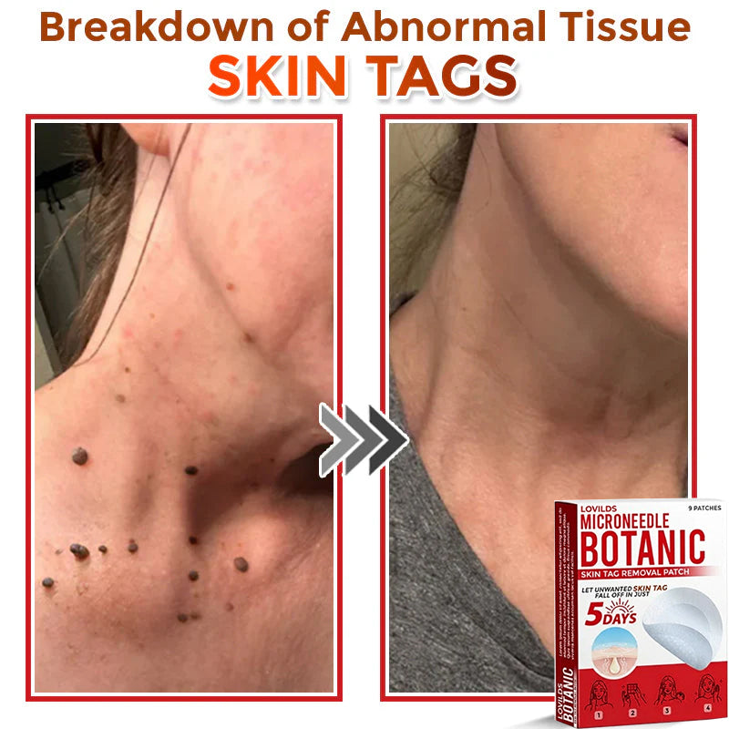 LOVILDS™-Removal Patch