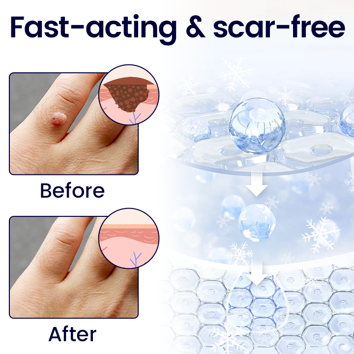 BBOJI® Wart Erase Cryo Freeze Spray