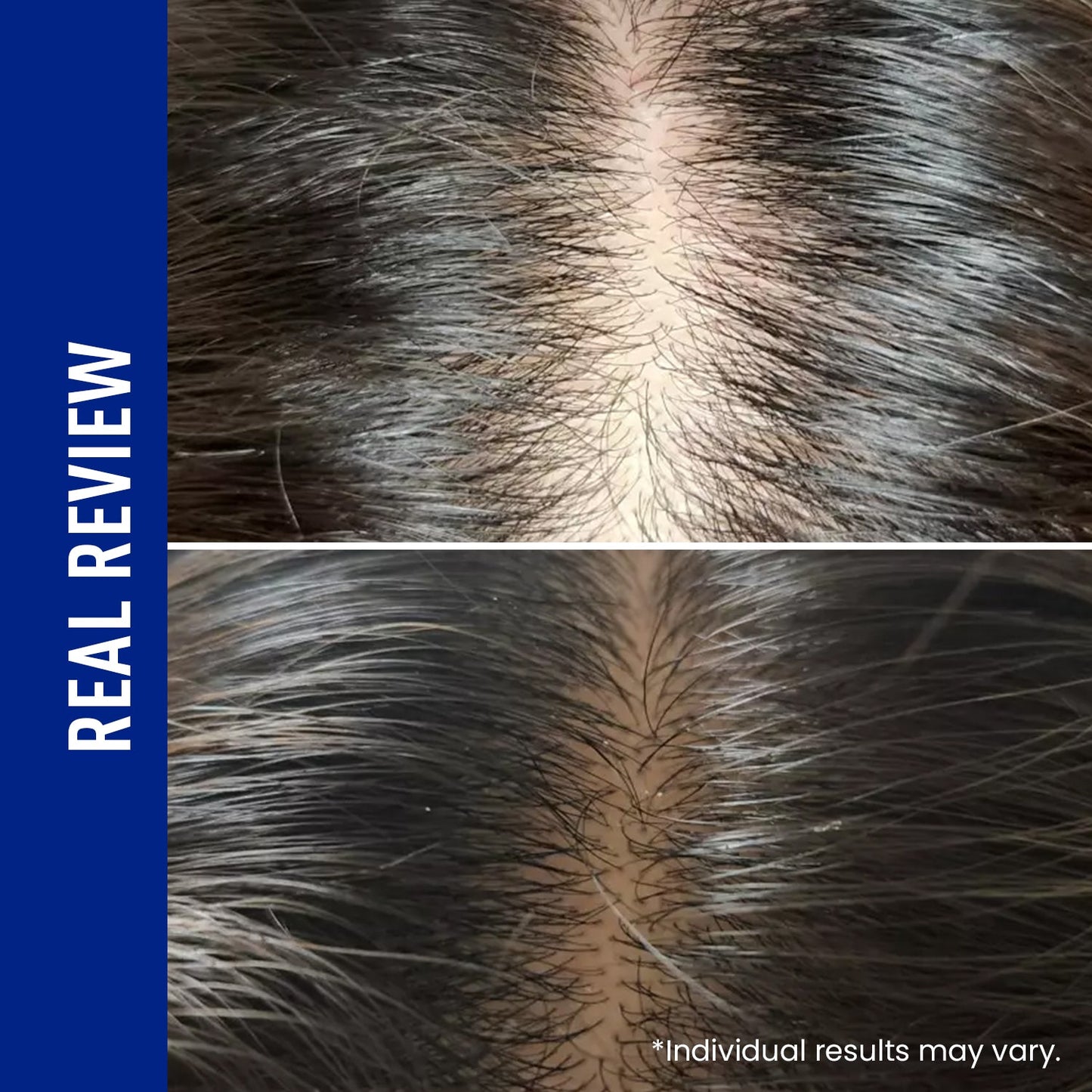 LOVILDS® Scalp Serum 400 – 220K Micro-Spicules for Thicker, Fuller Hair | Korea’s Best-Selling Dermatologist-Recommended K-Beauty Scalp Serum (0.5 fl oz)