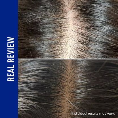 LOVILDS® Scalp Serum 400 – 220K Micro-Spicules for Thicker, Fuller Hair | Korea’s Best-Selling Dermatologist-Recommended K-Beauty Scalp Serum (0.5 fl oz)