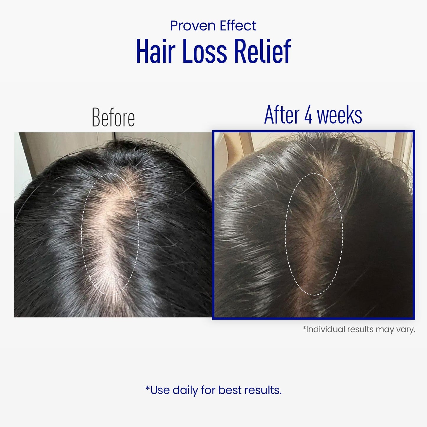 LOVILDS® Scalp Serum 400 – 220K Micro-Spicules for Thicker, Fuller Hair | Korea’s Best-Selling Dermatologist-Recommended K-Beauty Scalp Serum (0.5 fl oz)