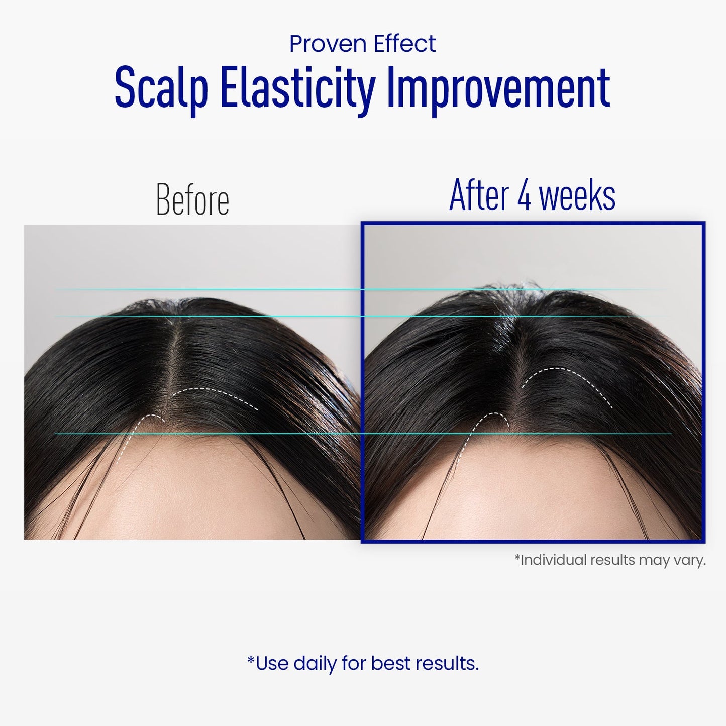 LOVILDS® Scalp Serum 400 – 220K Micro-Spicules for Thicker, Fuller Hair | Korea’s Best-Selling Dermatologist-Recommended K-Beauty Scalp Serum (0.5 fl oz)