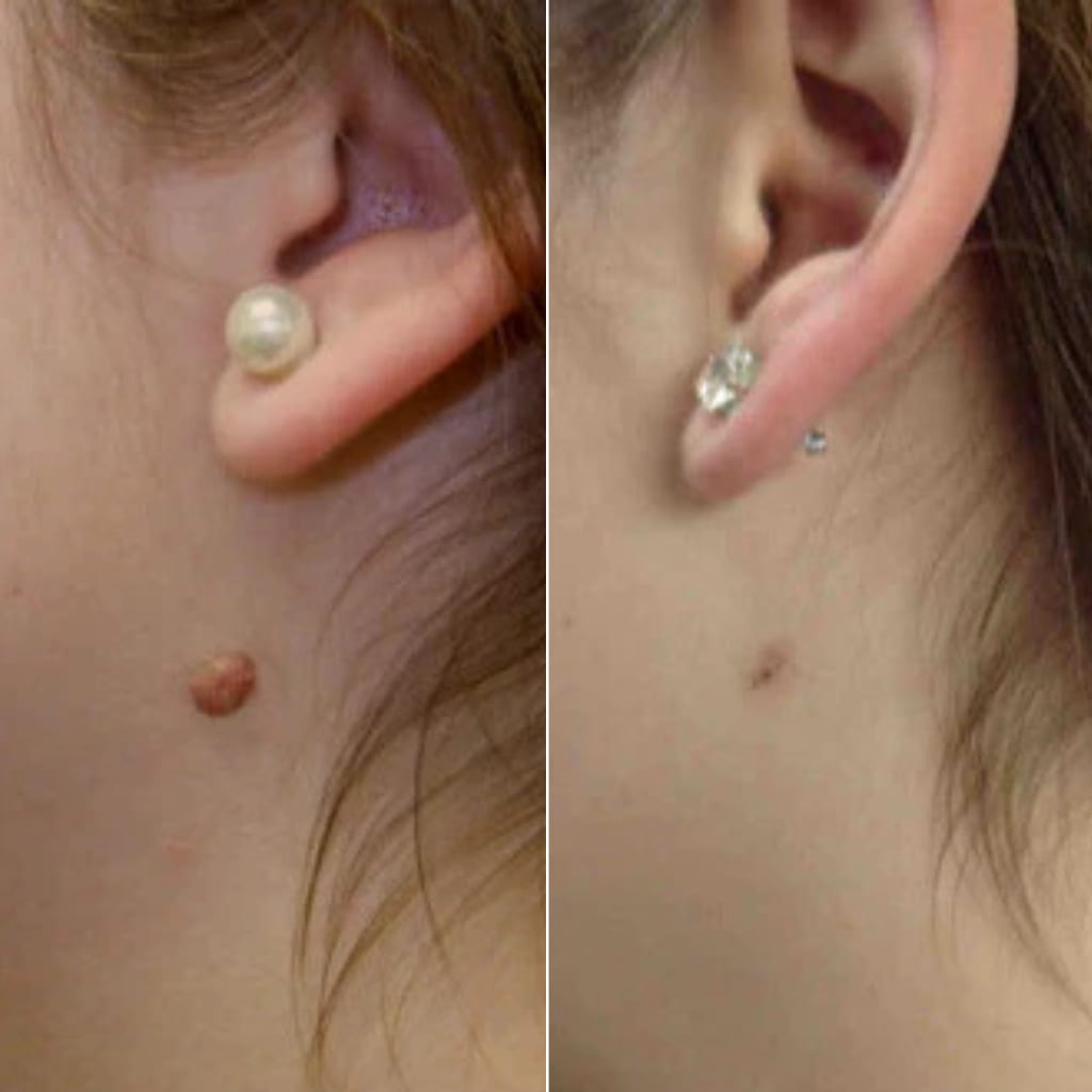 LOVILDS® – Skin Wart & Skin Tag Removal Kit